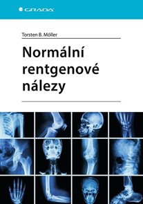 Norm&#225;ln&#237; rentgenov&#233; n&#225;lezy